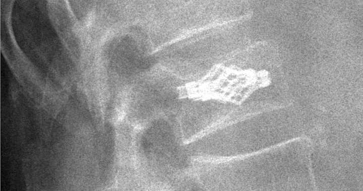 Titankäfig-Implantat.jpg
