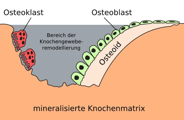 Knochenumbau bei Osteoporose