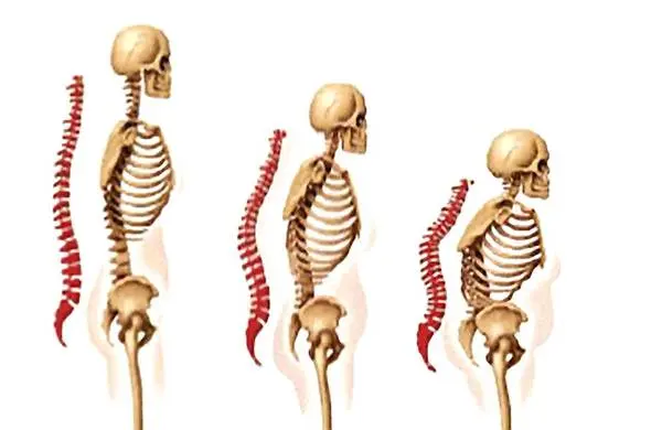 osteoporose_kyphose.jpg
