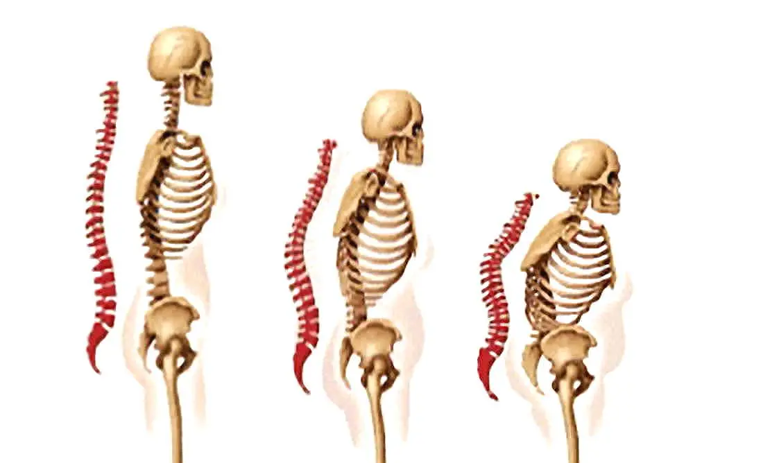 Osteoporose Kyhopse Osteoporose Kyhopse Wittwenbuckel