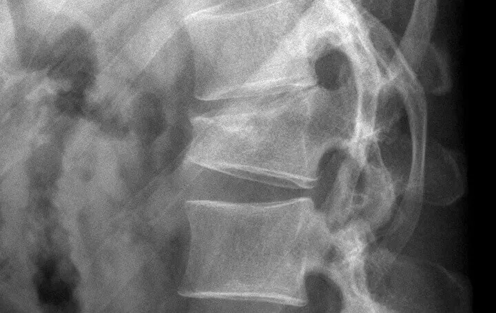 Osteoporose Fraktur Ausschnitt Osteoporose Fraktur Ausschnitt