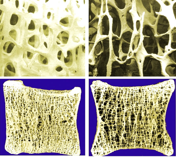 Spongiosa, Trabekel, Knochenbälkchen bei Osteoporose